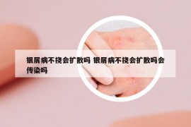 银屑病不挠会扩散吗 银屑病不挠会扩散吗会传染吗