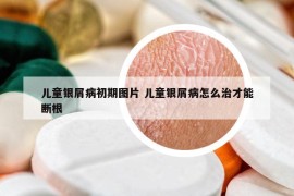 儿童银屑病初期图片 儿童银屑病怎么治才能断根