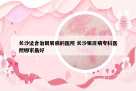 长沙适合治银屑病的医院 长沙银屑病专科医院哪家最好