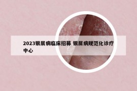 2023银屑病临床招募 银屑病规范化诊疗中心