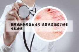 银屑病前胸后背有成片 银屑病后背起了好多小红疙瘩