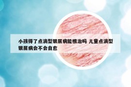 小孩得了点滴型银屑病能根治吗 儿童点滴型银屑病会不会自愈