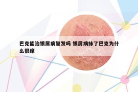 巴克能治银屑病复发吗 银屑病抹了巴克为什么很痒