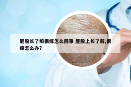 屁股长了癣很痒怎么回事 屁股上长了藓,很痒怎么办?