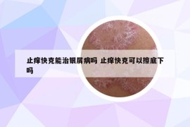 止痒快克能治银屑病吗 止痒快克可以擦底下吗