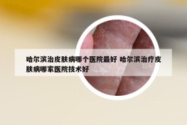 哈尔滨治皮肤病哪个医院最好 哈尔滨治疗皮肤病哪家医院技术好