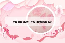 牛皮癣如何治疗 牛皮初期癣症怎么治