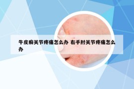 牛皮癣关节疼痛怎么办 右手肘关节疼痛怎么办