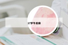 17岁牛皮癣