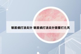 银屑病打消炎针 银屑病打消炎针需要打几天