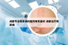 成都专治银屑病的医院哪家最好 成都治疗银屑病