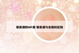 银屑病和MF病 银屑病与皮癣的区别