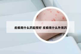 皮癣用什么药能擦好 皮癣用什么外用药