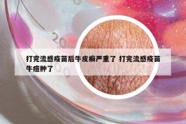 打完流感疫苗后牛皮癣严重了 打完流感疫苗牛痘肿了