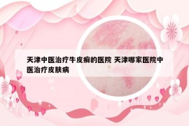 天津中医治疗牛皮癣的医院 天津哪家医院中医治疗皮肤病