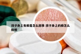 孩子身上有癣是怎么回事 孩子身上的癣怎么除根