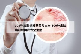 100种皮肤病对照图片大全 100种皮肤病对照图片大全坐疤