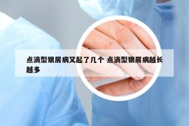 点滴型银屑病又起了几个 点滴型银屑病越长越多