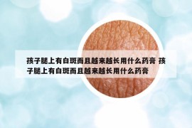 孩子腿上有白斑而且越来越长用什么药膏 孩子腿上有白斑而且越来越长用什么药膏