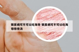 银屑病可不可以吃海带 银屑病可不可以吃海带排骨汤