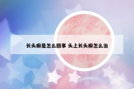 长头癣是怎么回事 头上长头癣怎么治