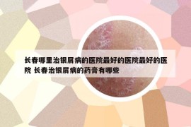 长春哪里治银屑病的医院最好的医院最好的医院 长春治银屑病的药膏有哪些