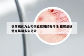 银屑病达力士和他克莫司经典疗法 银屑病抹他克莫司多久见效