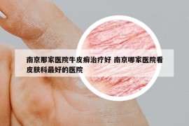 南京那家医院牛皮癣治疗好 南京哪家医院看皮肤科最好的医院