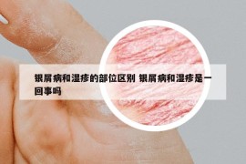 银屑病和湿疹的部位区别 银屑病和湿疹是一回事吗