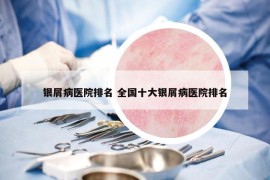 银屑病医院排名 全国十大银屑病医院排名