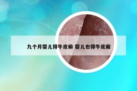 九个月婴儿得牛皮癣 婴儿也得牛皮廨