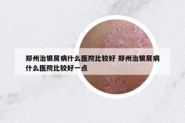 郑州治银屑病什么医院比较好 郑州治银屑病什么医院比较好一点