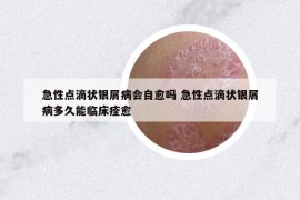 急性点滴状银屑病会自愈吗 急性点滴状银屑病多久能临床痊愈