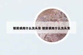 银屑病用什么洗头膏 银屑病用什么洗头发