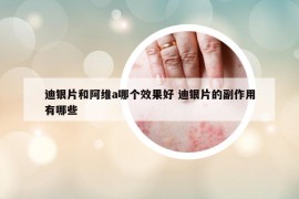 迪银片和阿维a哪个效果好 迪银片的副作用有哪些