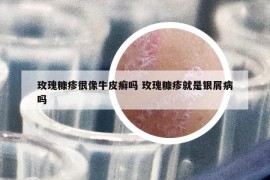 玫瑰糠疹很像牛皮癣吗 玫瑰糠疹就是银屑病吗