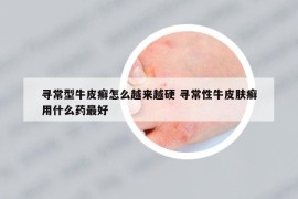 寻常型牛皮癣怎么越来越硬 寻常性牛皮肤癣用什么药最好