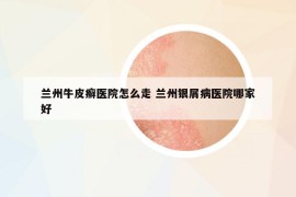 兰州牛皮癣医院怎么走 兰州银屑病医院哪家好