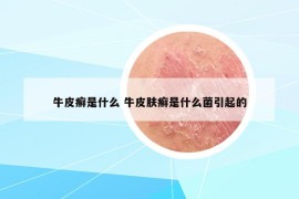 牛皮癣是什么 牛皮肤癣是什么菌引起的