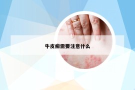 牛皮癣需要注意什么