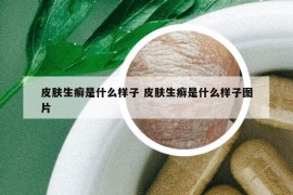 皮肤生癣是什么样子 皮肤生癣是什么样子图片