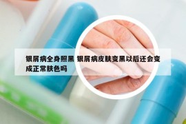 银屑病全身照黑 银屑病皮肤变黑以后还会变成正常肤色吗