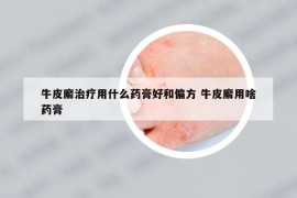 牛皮廨治疗用什么药膏好和偏方 牛皮廨用啥药膏