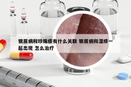 银屑病和珍珠疹有什么关联 银屑病和湿疹一起出现 怎么治疗