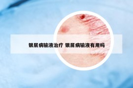 银屑病输液治疗 银屑病输液有用吗