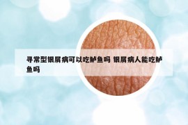 寻常型银屑病可以吃鲈鱼吗 银屑病人能吃鲈鱼吗