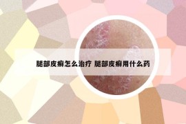 腿部皮癣怎么治疗 腿部皮癣用什么药