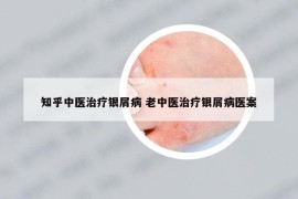 知乎中医治疗银屑病 老中医治疗银屑病医案