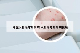 中医火针治疗银屑病 火针治疗银屑病视频