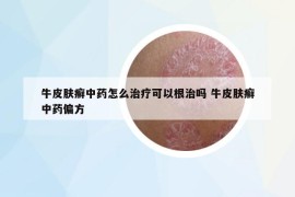 牛皮肤癣中药怎么治疗可以根治吗 牛皮肤癣中药偏方